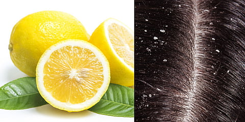 कोंड्याची समस्या लिंबू करु शकते दूर; करा हे उपाय