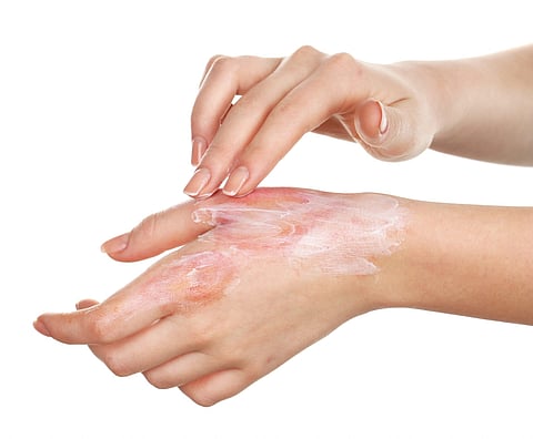 त्वचेची जळजळ होत असेल तर हे उपाय करा