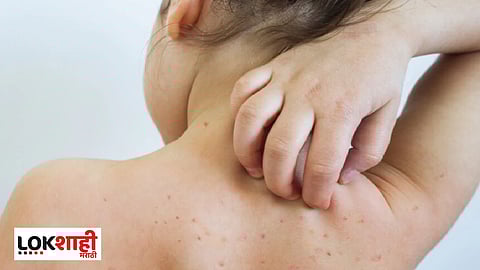 Measles Outbreak in Maharashtra