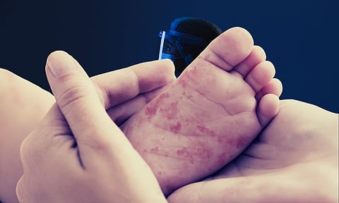 मुंबईत गोवरने एक वर्षीय बालकाचा मृत्यू; महापालिकेकडून मृत्यू लपवण्याचा प्रयत्न?