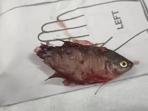 मासा गिळल्याने 6 महिन्याच्या बाळाचा मृत्यू