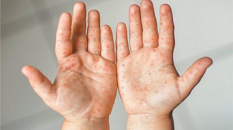 मुंबईत गोवरचा उद्रेक; गोवरची एकूण रुग्णसंख्या 126 वर