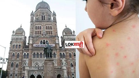 Mumbai Measles Disease