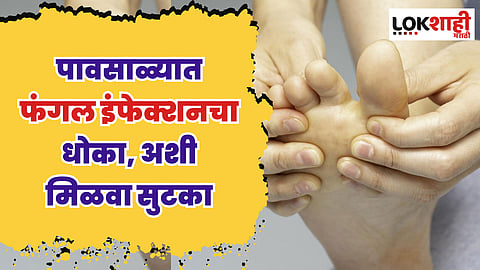Monsoon Tips: पावसाळ्यात फंगल इंफेक्शनचा धोका, अशी मिळवा सुटका