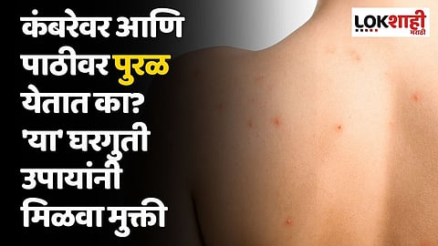 कंबरेवर आणि पाठीवर पुरळ येतात का? 'या' घरगुती उपायांनी मिळवा मुक्ती