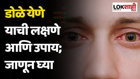 डोळे येणे यावर उपाय आणि संपूर्ण माहिती, जाणून घ्या...