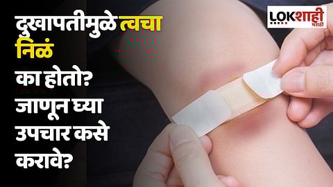 दुखापतीमुळे त्वचा निळं का होतो? जाणून घ्या उपचार कसे करावे?