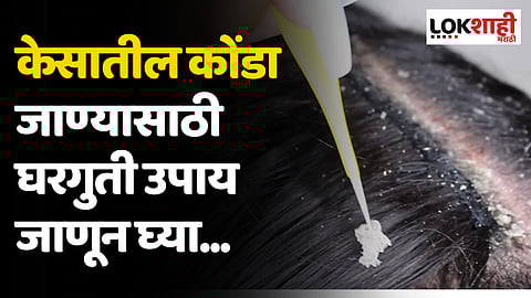 केसातील कोंडा घालवण्यासाठी सोपे घरगुती उपाय, जाणून घ्या...