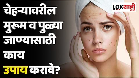 Pimples Home Remedies : चेहऱ्यावर पिंपल्स येण्याची कारणे व घरगुती उपाय