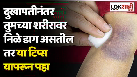 Tips for Bruises : दुखापतीनंतर तुमच्या शरीरावर निळे डाग असतील तर 'या' टिप्स वापरून पहा