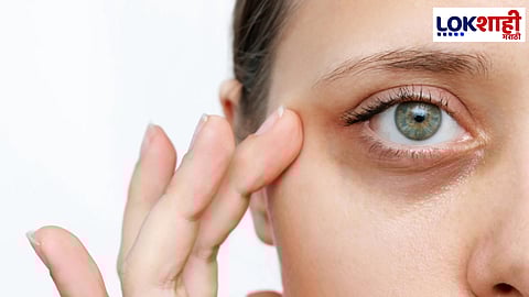 Dark circles: डोळ्याखालील ब्लॅक सर्कल तयार झाले आहेत? ब्लॅक सर्कलवर "हे" उपाय हमखास ट्राय करा