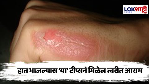 Home Remedies : स्वयंपाकात चटका लागल्यास घरीच करा हे सोपे उपचार