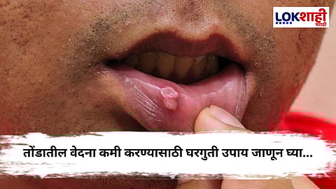 Home Remedies To Relieve Mouth Pain : तोंडातील फोडं, जळजळ आणि वेदना? आता मिळवा त्वरित आराम!