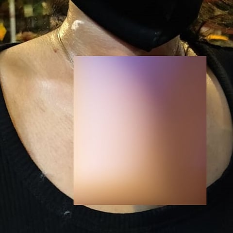 लोकलच्या महिला डब्यात चढून तरुणीवर ब्लेडने वार