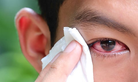 வேகமாக பரவி வரும் மெட்ராஸ்-ஐ... தொற்று பரவாமல் தடுப்பது எப்படி? - டாக்டர் விளக்கம்