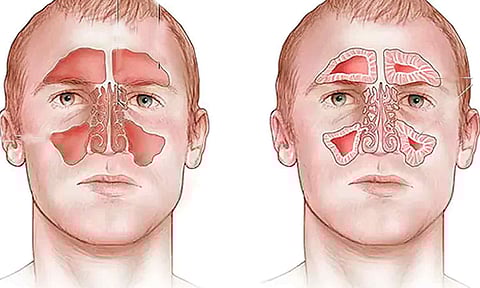 சைனஸ் பிரச்சனை இருப்பதை உணர்த்தும் சில அறிகுறிகள்