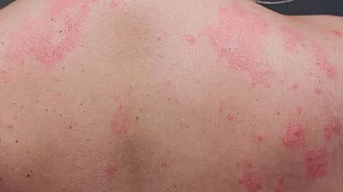 படை நோய்: காரணங்களும்.. தடுக்கும் வழிமுறைகளும்..!