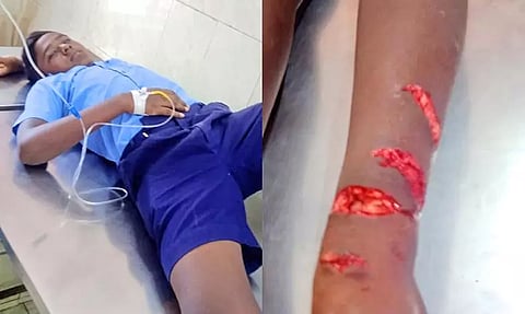 குரங்கு கடித்ததில் படுகாயம் அடைந்த சிறுவன் கவின்.