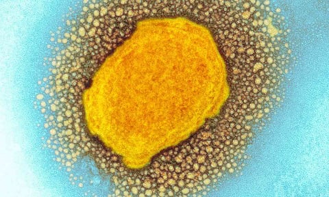 உலகிலேயே முதல்முறையாக இத்தாலி வாலிபருக்கு கொரோனா, குரங்கு அம்மை, எச்.ஐ.வி. பாதிப்பு