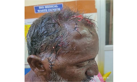 பிராந்தி பாட்டிலால் பெயிண்டர் மண்டையை உடைத்த வாலிபர்