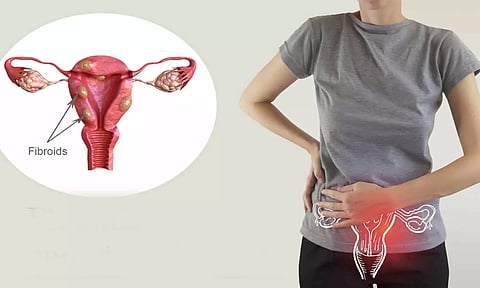 கருப்பை சார்ந்த கட்டிகளும் சித்த மருத்துவமும்...