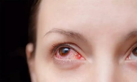 'மெட்ராஸ் ஐ'... குணப்படுத்தும் சித்த மருந்துகள்