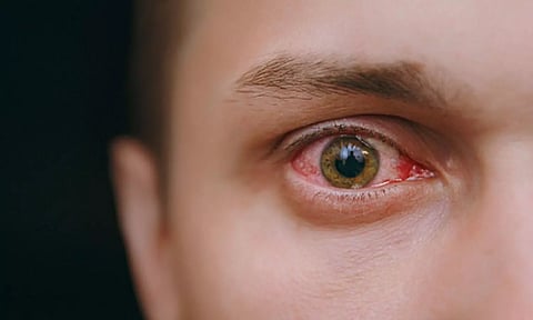 மெட்ராசை போட்டு தாக்கும் 'மெட்ராஸ்-ஐ': தினமும் 100-க்கும் மேற்பட்டவர்கள் பாதிப்பு