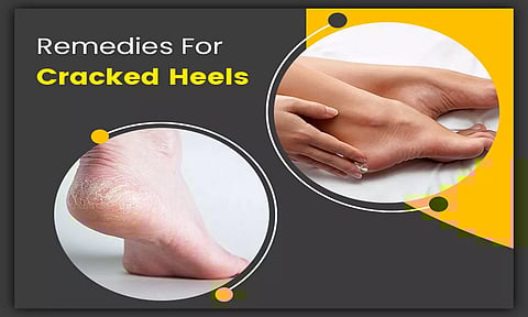 கால் அழகை கெடுக்கும் பித்த வெடிப்பு வரக்காரணமும்... தடுக்கும் வழிமுறையும்...