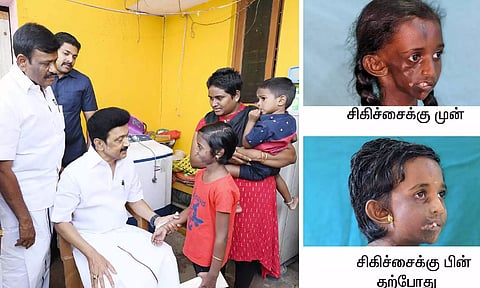 சிறுமி தானியா வீட்டுக்கு சென்ற முதலமைச்சர் மு.க.ஸ்டாலின்- உடல்நலம் குறித்து விசாரித்தார்
