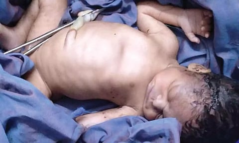 சேலம் அரசு மருத்துவமனையில் சிகிச்சை பெற்று வரும் குழந்தை