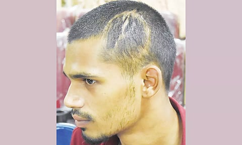 மண்டை ஓடு உடைந்தால் உலோக மண்டை ஓடு- கீழ்ப்பாக்கம் அரசு ஆஸ்பத்திரியில் முதல்முறையாக பொருத்தப்பட்டது