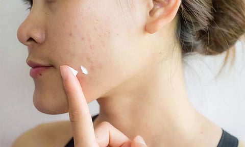 சருமத்தில் உள்ள தழும்புகளை நீக்கும் கோகோ பட்டர்