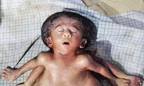 பீகாரில் இரண்டு இதயம், 4 கால்கள், 4 கைகள், 4 காதுகளுடன் பிறந்த அதிசய குழந்தை