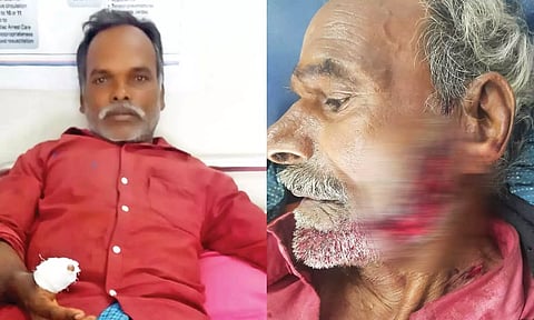 கரடி தாக்கியதில் காயமடைந்த விவசாயிகள்.