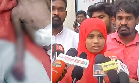 எழும்பூர் அரசு மருத்துவமனையில் கை அகற்றப்பட்ட குழந்தை உயிரிழப்பு