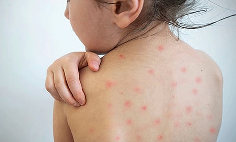 கீழக்கரையில் அதிகரித்து வரும் தட்டம்மை நோயால் பெற்றோர்கள் அச்சம்