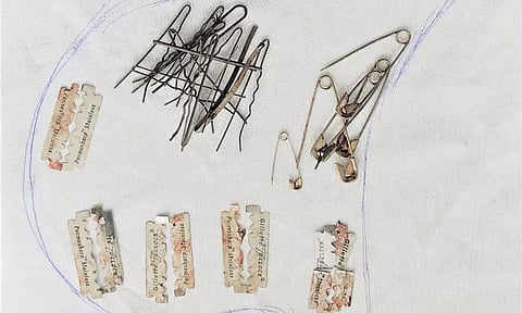 வாலிபரின் வயிற்றில் இருந்து அகற்றப்பட்ட ஹேர்பின், பிளேடு, ஊக்குகள்