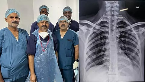 எண்டோஸ்கோபி மூலம் ஊக்கை அகற்றிய டாக்டர்கள் குழுவினரும். உணவுக் குழாயில் சிக்கி உள்ள ஊக்கையும் படத்தில் காணலாம்