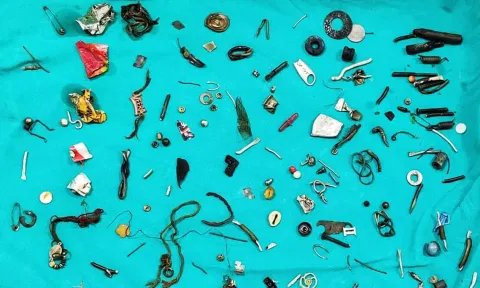 "வயிறா இல்லை வேர்ஹவுஸா?"; நோயாளி வயிற்றில் உலோகங்கள்: அதிர்ந்த மருத்துவர்கள்