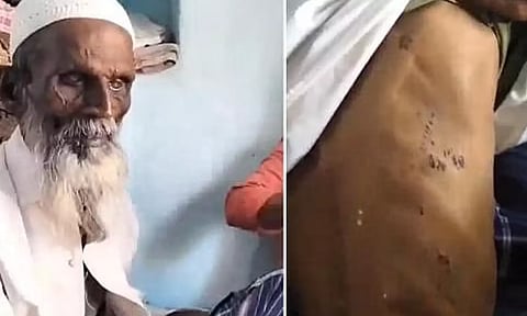 "ஜெய் ஸ்ரீராம்" என சொல்ல மறுத்த இஸ்லாமியரை தாக்கி, தாடியில் தீ வைத்த மர்ம நபர்கள்- போலீஸ் விசாரணை