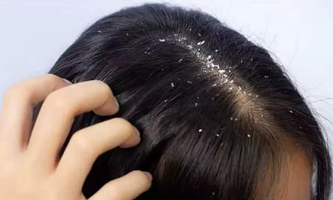 பொடுகு தொல்லைக்கு ஆயுர்வேத வைத்தியம்