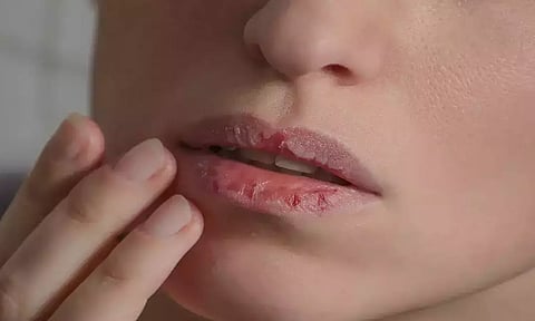 குளிர்காலத்தில் உதடுகளில் தோல் உரிவதை தடுக்கும் வழிகள்