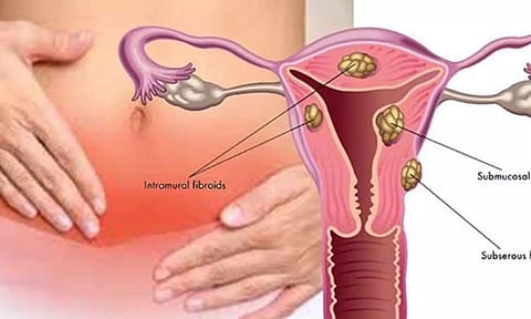 கருப்பை வாய் புற்றுநோயை தவிர்க்க சில டிப்ஸ்...!
