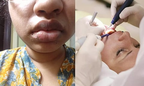 பல் சிகிச்சையின் போது துண்டான உதடு: தொடர்ந்து சர்ச்சையில் சிக்கும் ஹைதராபாத் மருத்துவமனை