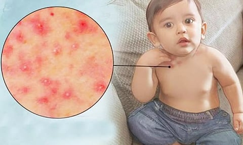 கோடை காலத்தில் குழந்தைகளுக்கு வியர்க்குரு வராமல் தடுப்பது எப்படி...?