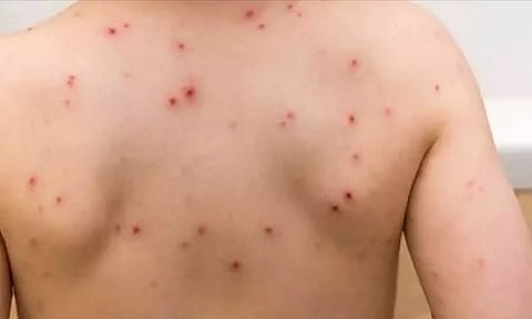 "அம்மை" பாதிப்பு அதிகரிப்பு: தடுப்பூசி போட்டுக்கொள்ள டாக்டர்கள் அறிவுறுத்தல்