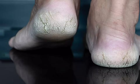 பாத வெடிப்புகளை போக்க உதவும் வீட்டுக்குறிப்புகள்