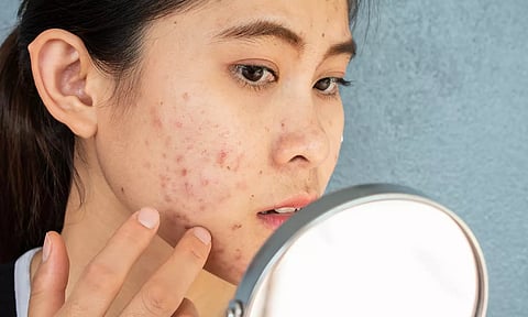 பருக்கள் வராமல் தடுப்பதற்கான சில வழிகள்