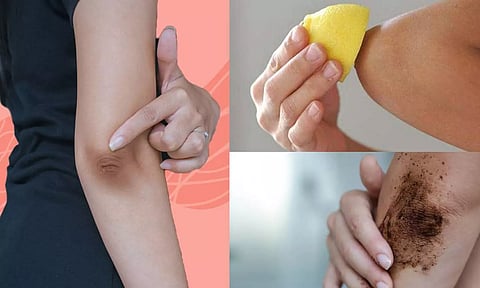 முழங்கை கருப்பை அகற்றுவது எப்படி...?