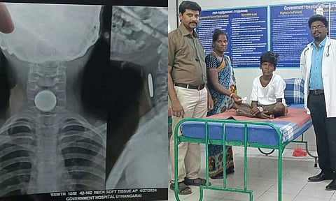 தொண்டை பகுதியில் சிக்கி இருந்த 5 ரூபாய் நாணயம் - சிகிச்சை அளித்த மருத்துவர்களும், சிறுவன் வினித்தையும் காணலாம்